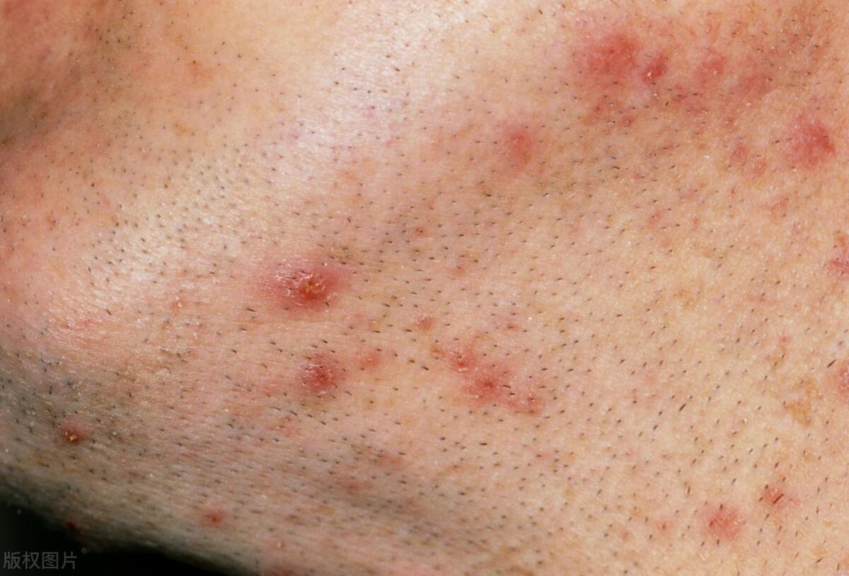 皮肤长红色疹子不痛不痒是什么病,肩膀上红色疹子不痛不痒