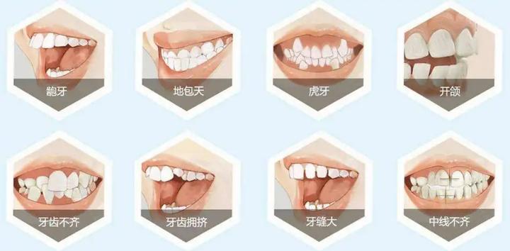 上下牙无法咬合是怎么回事,30岁牙齿咬合开颌还有必要矫正吗