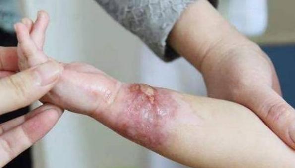 小孩被开水烫伤怎么办最快最有效,小孩被开水烫伤怎么处理最好恢复