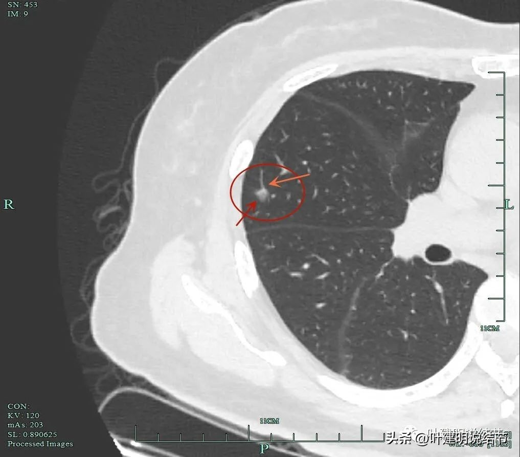 肺癌右中上叶全切,右肺上叶小结节查出是癌怎么办