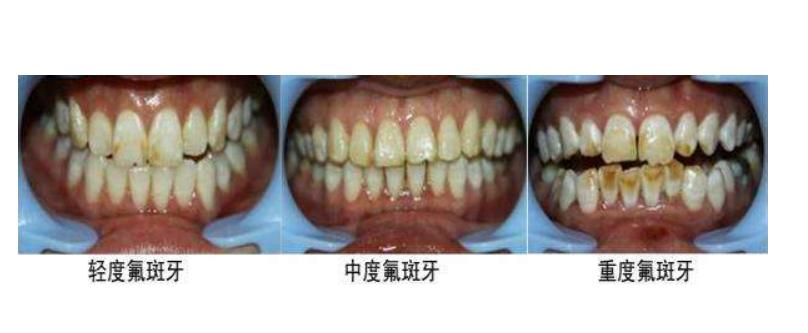 烤瓷牙的缺点危害亲身经历,烤瓷牙各有哪些优缺点