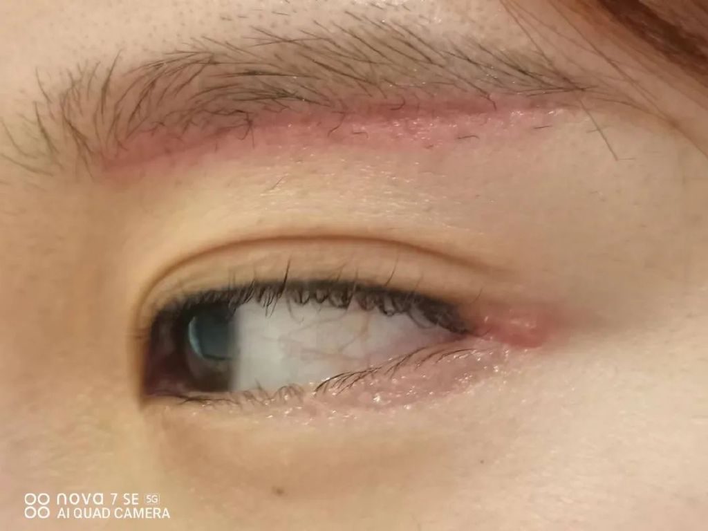 开外眼角优点和缺点,外眼角开的不明显还可以再开吗