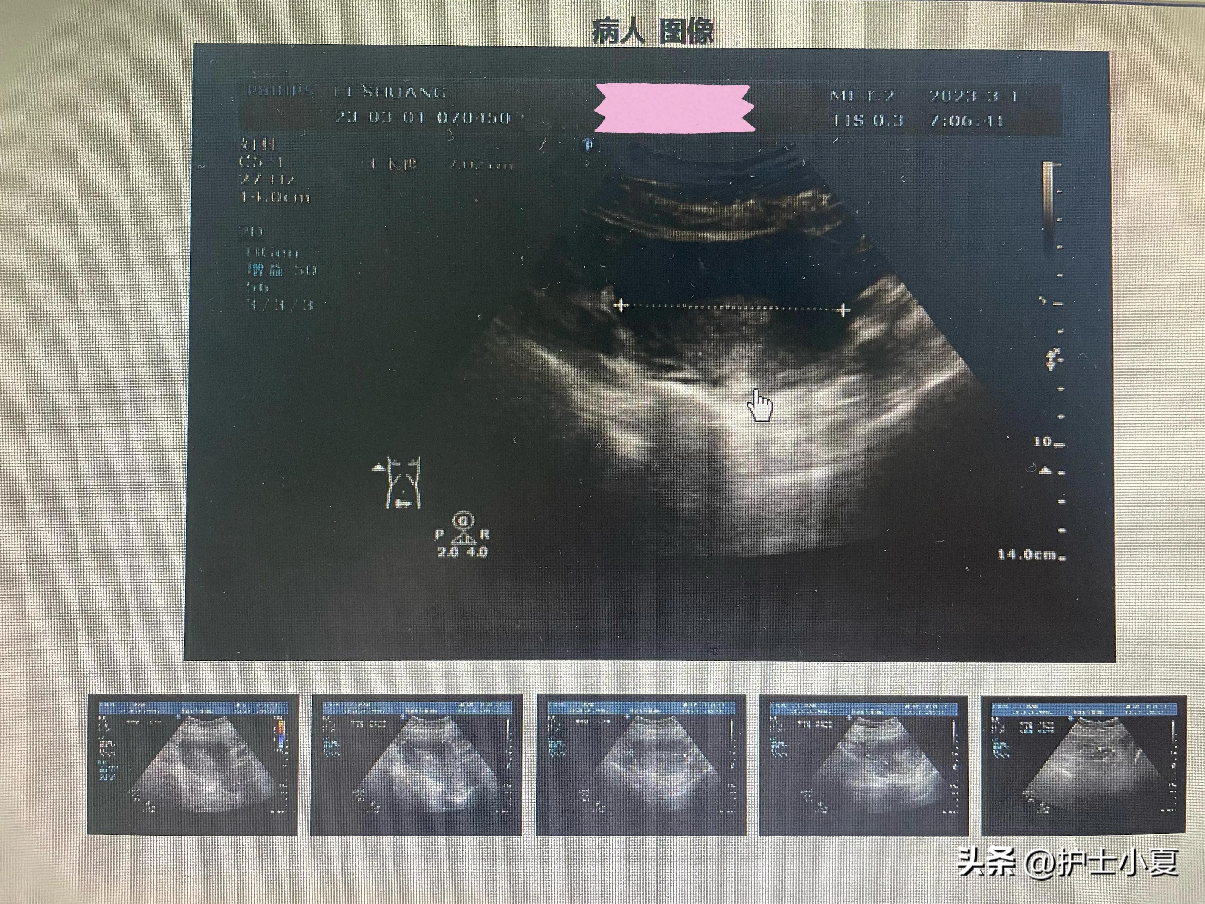 病例分享：25岁女孩，孕13周引产，引产后需要注意哪些？