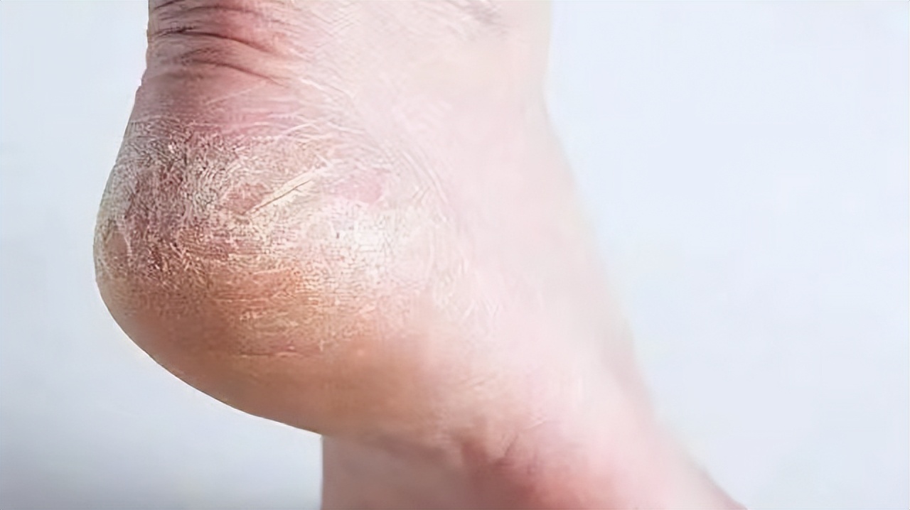 脚底板爱进风什么原因,脚底板长茧子走路疼怎么办