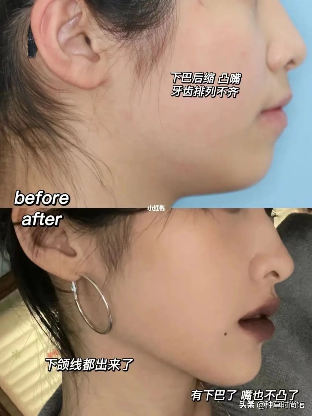 扁平脸淡颜变美思路,苦相女生长相怎么微调