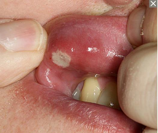 嘴巴里面长了好几个口腔溃疡好痛,口腔溃疡喷西瓜霜好痛是快好了吗