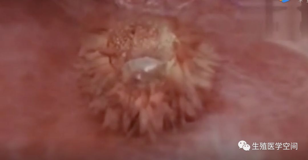 产前妊高症有什么危险,怀孕初期怎么可以促使生化妊娠