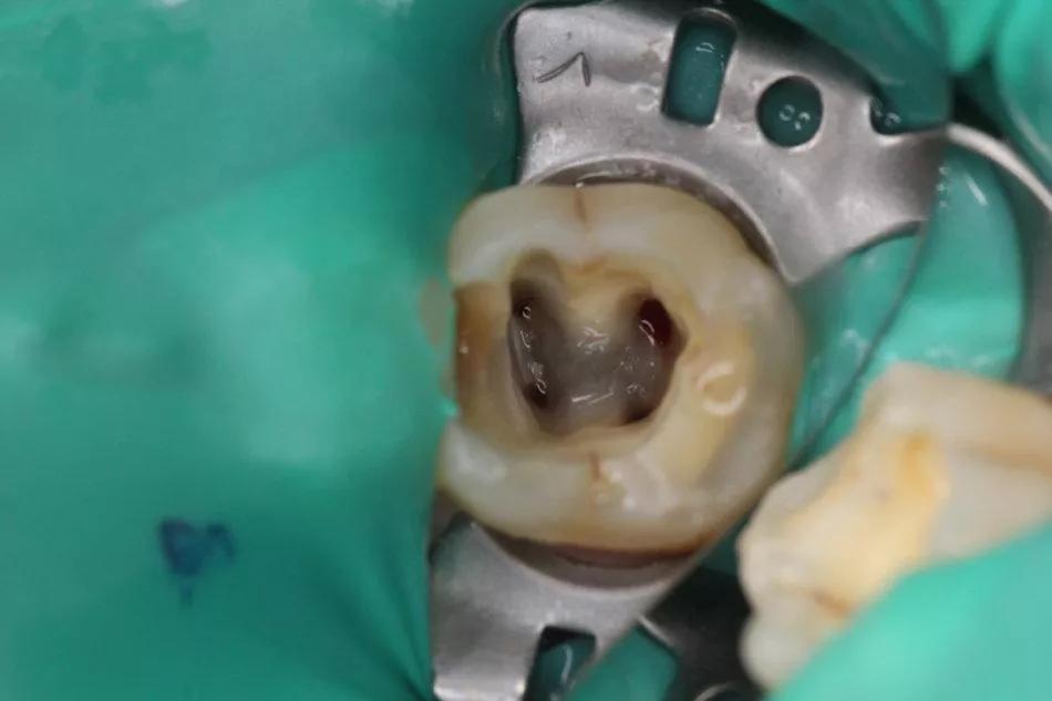 两颗牙根管治疗一次要多久,两颗牙根管治疗和牙套3000贵不