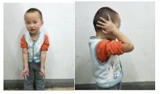 肱骨骨折取钢板怎样恢复,肱骨近端骨折切开复位内固定术