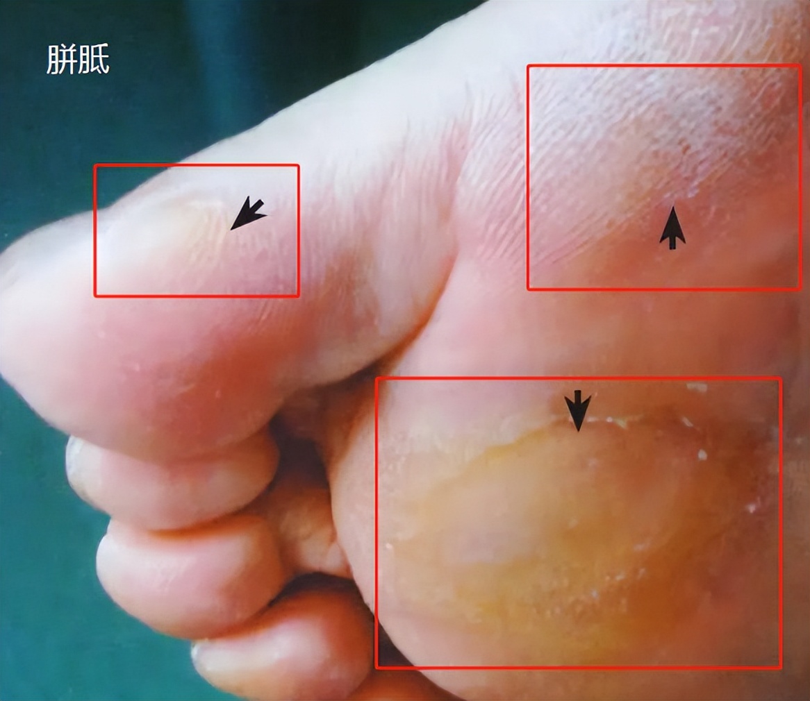 啥形状是鸡眼,什么形状是鸡眼