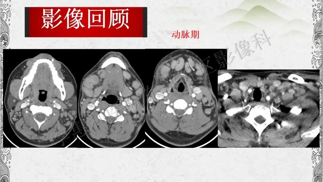 木村病治愈成功案例,木村病诊断案例