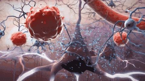 干细胞治疗脑疾病案例,干细胞治疗脑卒中3期临床试验