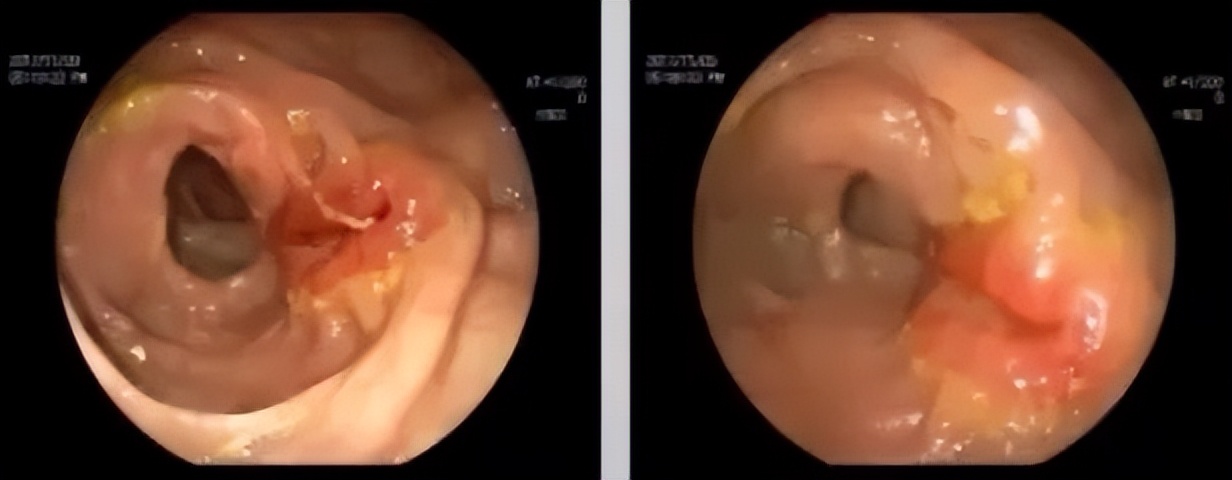 多原发癌症转移,多原发直肠癌
