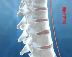 你的腰骨折过吗,你的腰椎