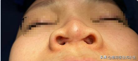 女子花7000去美容不料整成红鼻子,女子花7万整容做鼻子