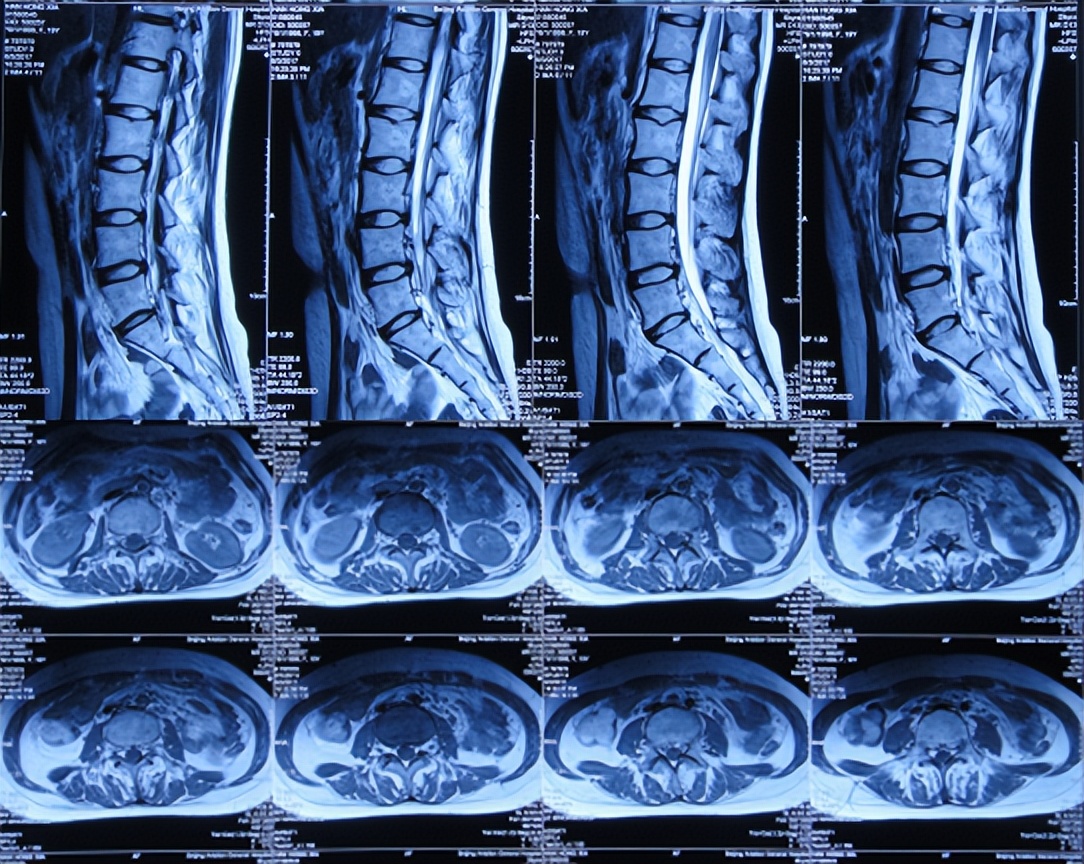 结核性脑积水能治愈吗,儿童结核脑膜炎脑积水