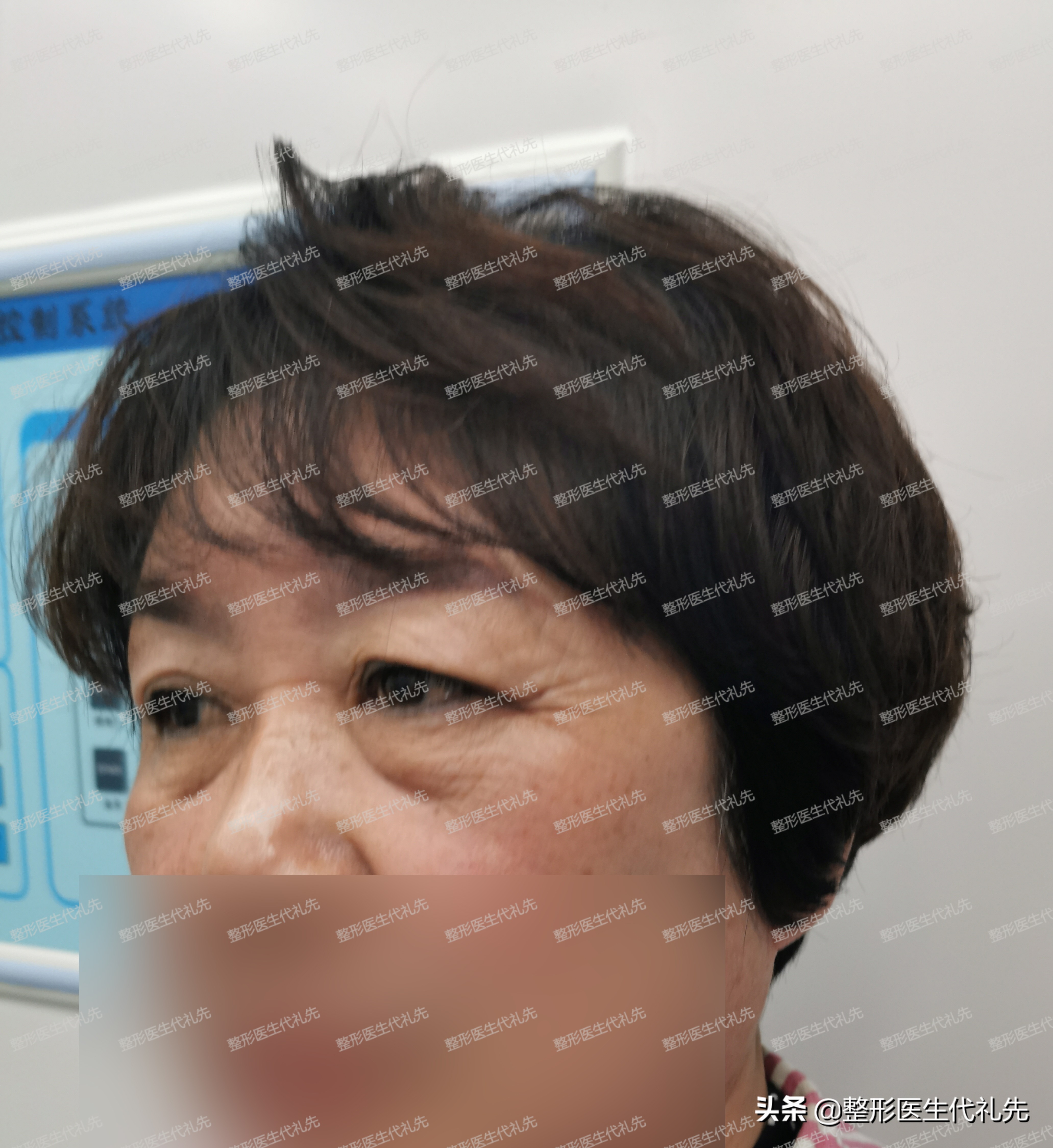 眼袋外切卧蚕留下卧蚕图片,眼袋和卧蚕有什么区别怎么祛眼袋