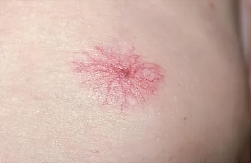 22岁女孩瘫痪在床与上千肿瘤对抗,22岁女子身体上千颗肿瘤