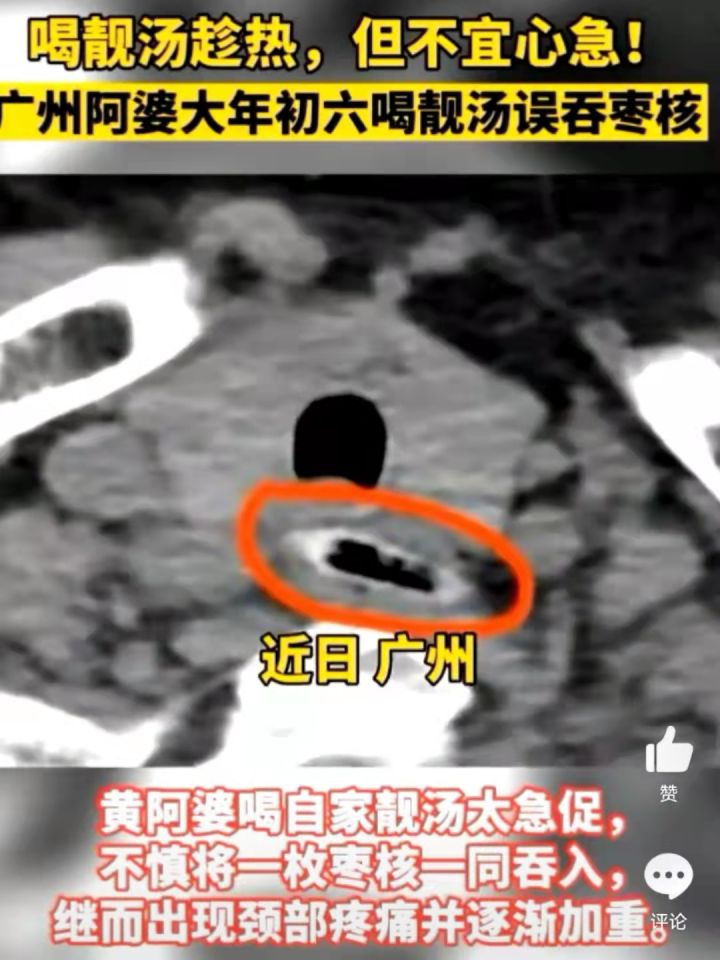 太危险5岁男童误吞11颗磁力珠,九岁男童误吞23颗磁力珠新闻