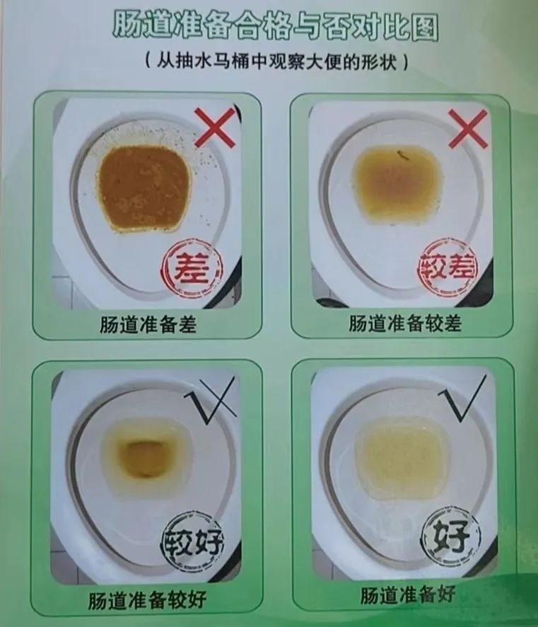 万万没想到，无意中做的胃肠镜，帮我捡回一条命