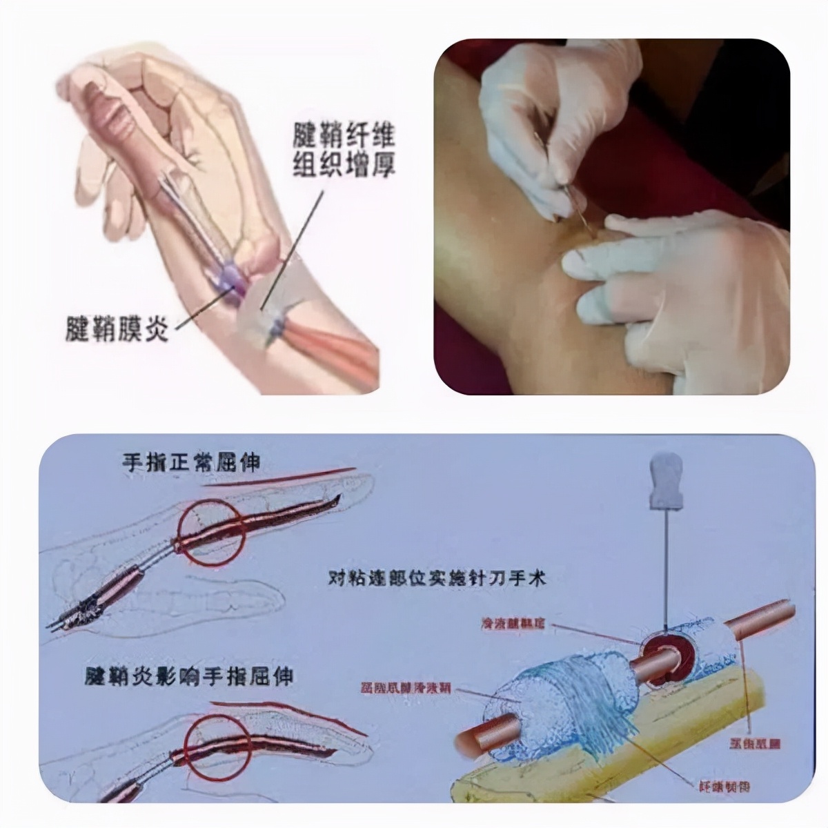 腕部筋疼啥原因,腕部疼痛如何治疗