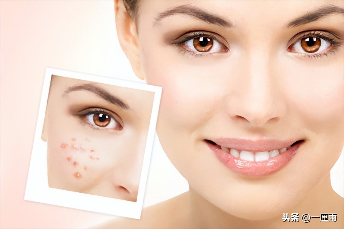 祛痘痘最快的方法不留痘印,怎么祛痘痘和痘印最有效的方法