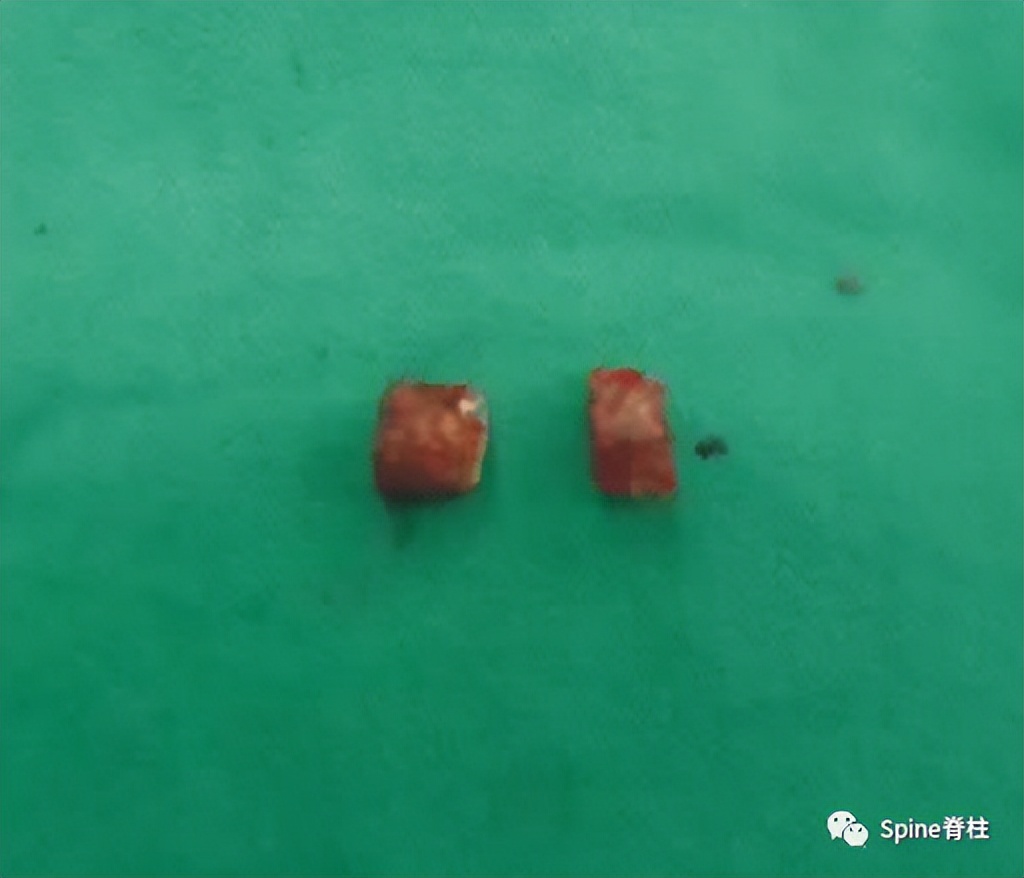 峡部裂和隐性峡部裂有区别吗,单纯峡部裂可以做峡部修复吗