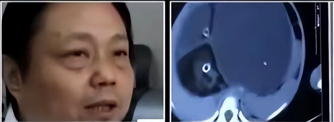 女童肚子超大疑似怀孕,2岁女婴肚中发现“胎儿”