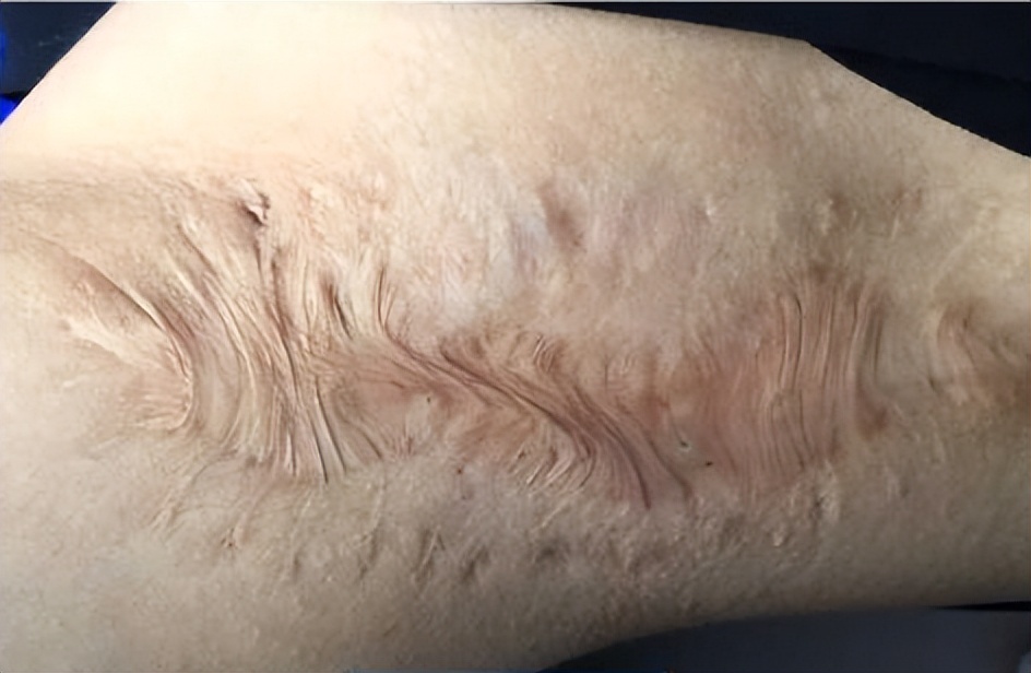 烧烫伤疤痕如何修复？烧烫伤疤痕怎么治疗？