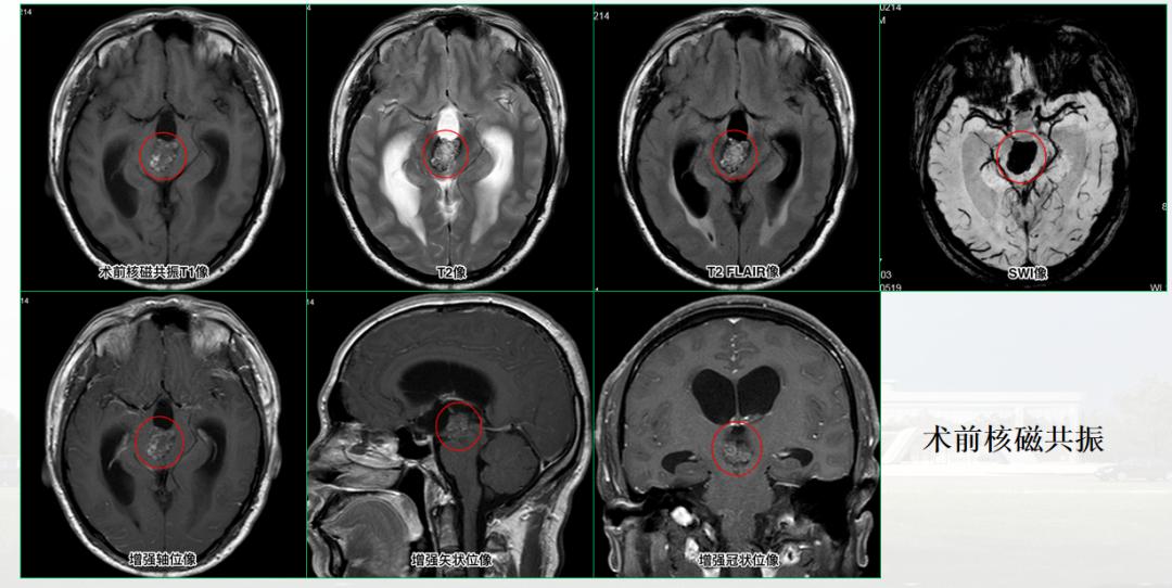 头部海绵状脑血管瘤3个办法消退,男子头痛查出心脏多个眼