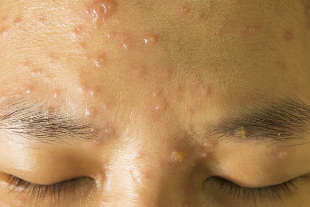 40岁出水痘要注意哪些,40多岁的人会不会得水痘