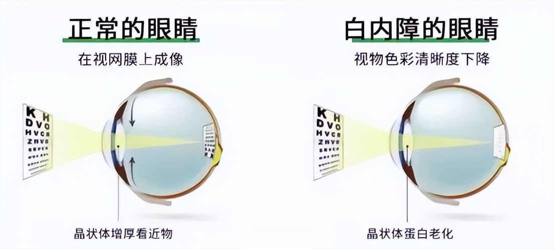 邯郸爱眼医院治疗白内障怎么样,邯郸爱眼医院做白内障免费吗