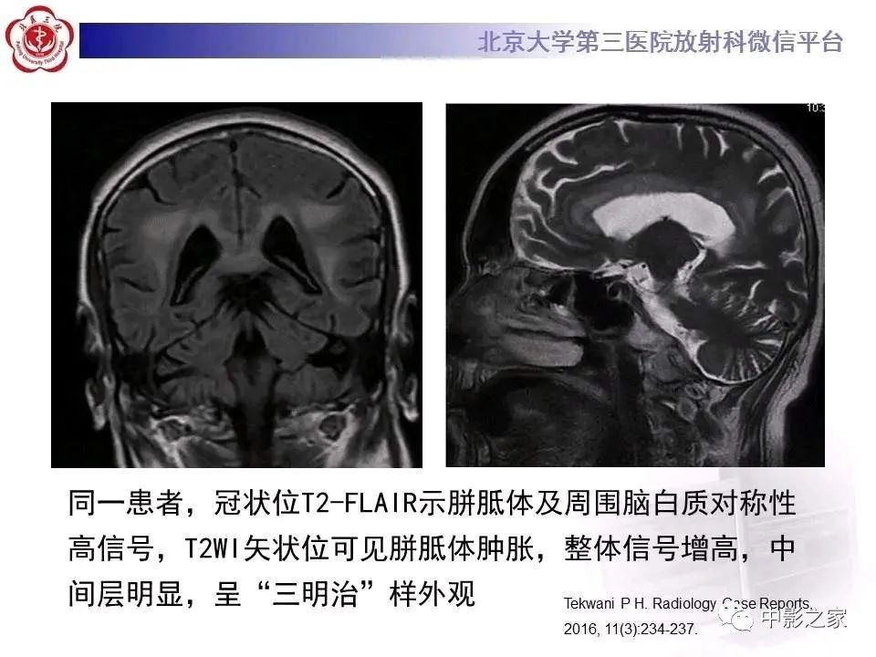 什么叫原发性胼胝体变性,原发性胼胝体变性治疗多少钱