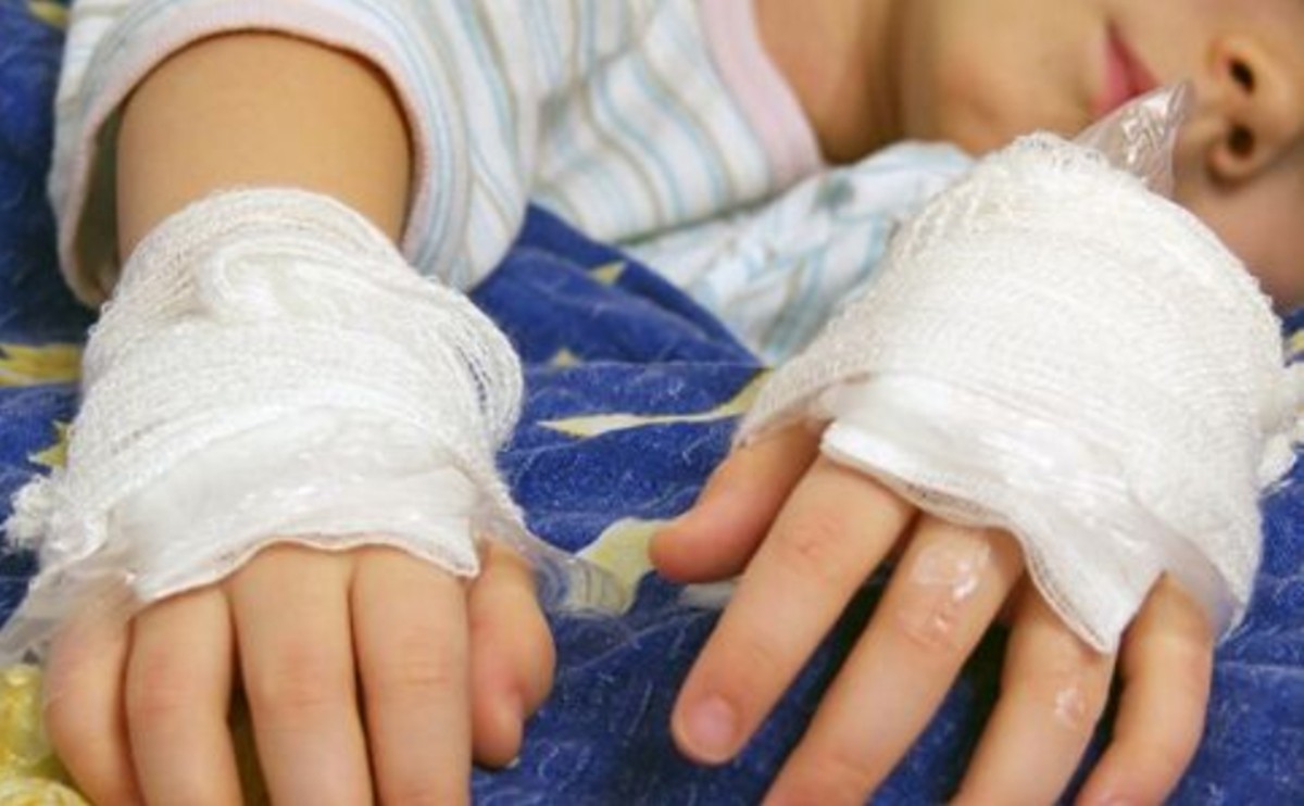 如果孩子被烫伤怎么正确处理,小孩被开水烫伤怎么处理好