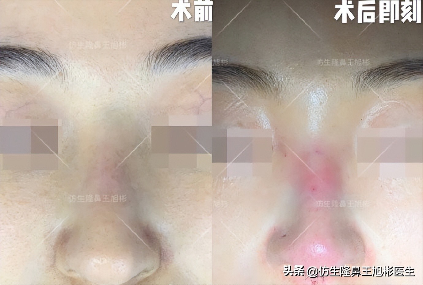 大鼻头能做直鼻微翘吗,可以只做鼻头缩小术吗