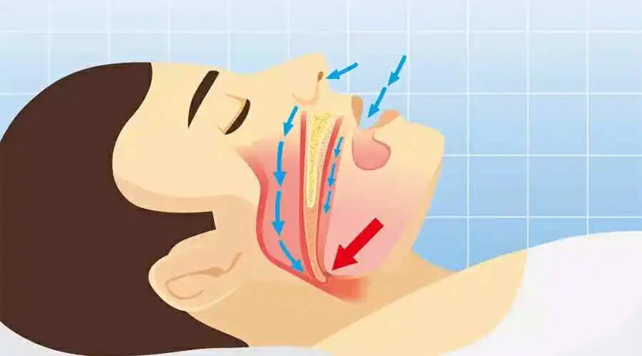 打鼾影响睡眠质量做什么手术,打鼾不仅影响他人还伤害自身