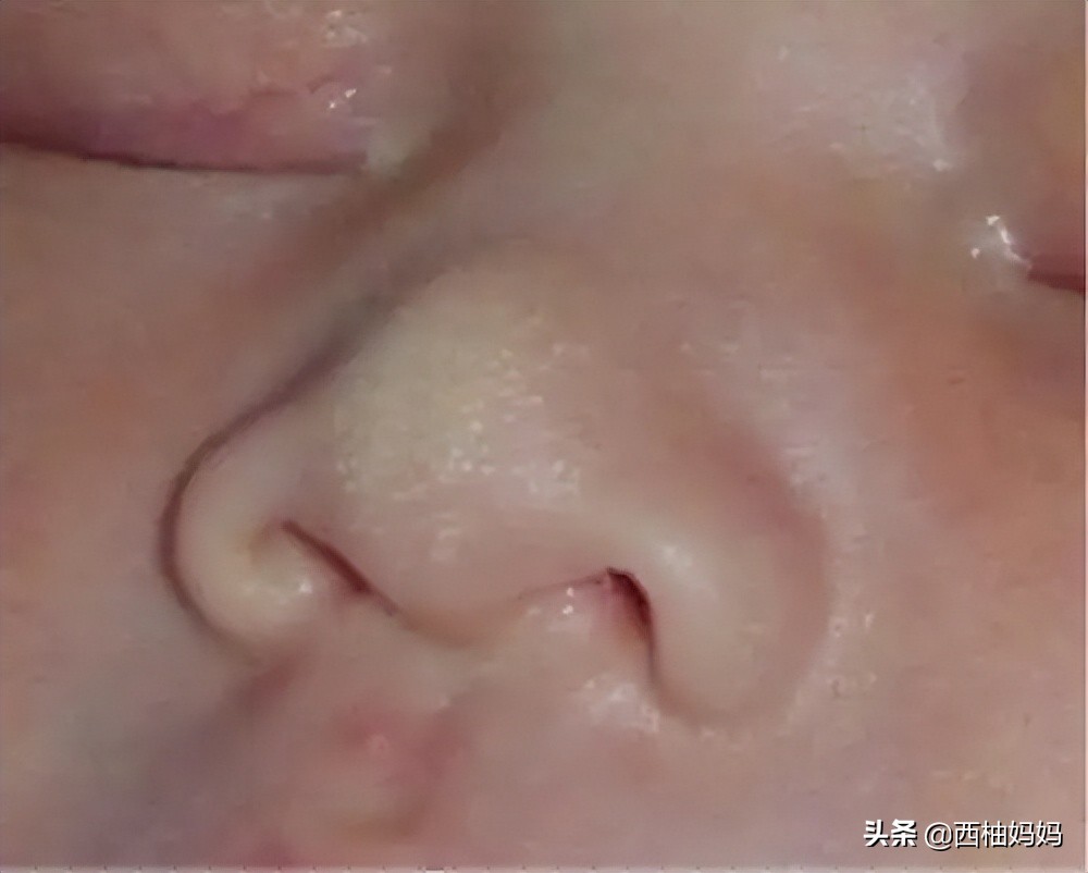 有湿疹的宝宝过敏是什么样的,宝宝过敏引起的湿疹需要去医院吗