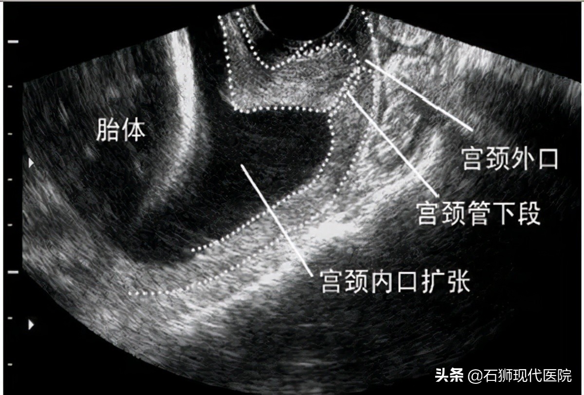 反复流产小心黄体功能不全,反复流产不要忽视男性因素