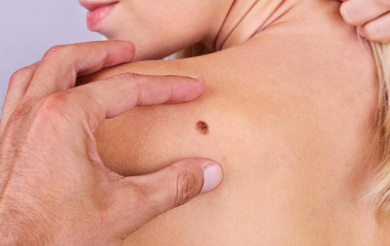 这8个部位长痣或是癌症前兆,痣长在身体这8个部位要小心癌症
