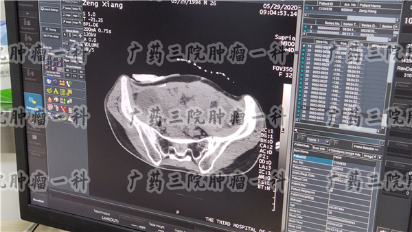 结肠癌腹腔积液严重吗,结肠癌患者有盆腔积液是转移吗