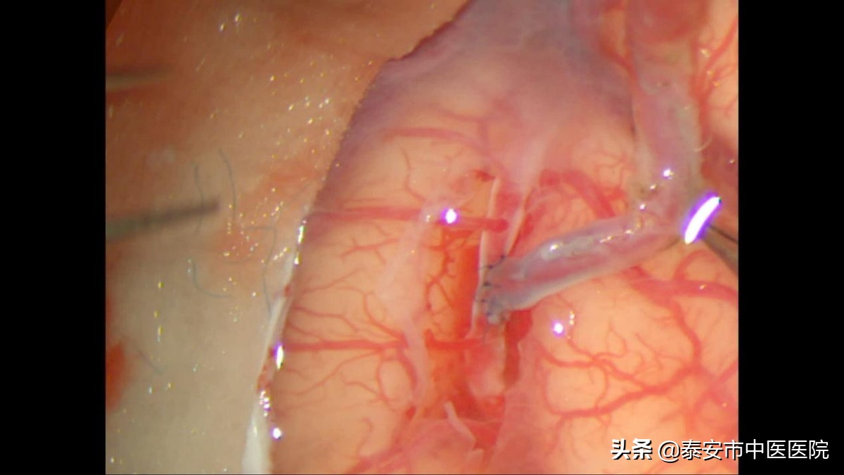 硬核技术!*安泰**市中医医院成功完成本院首例颅内外血管搭桥手术