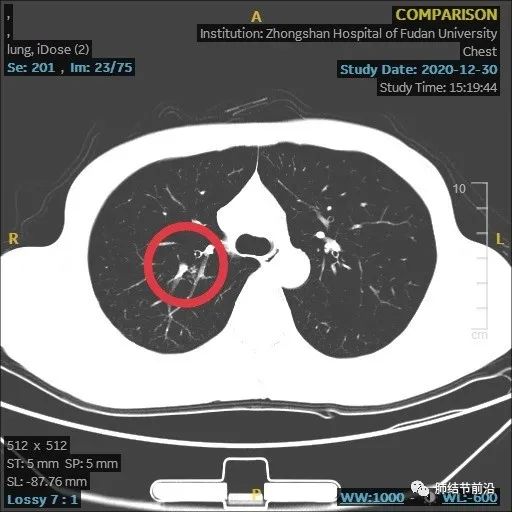 炎症引起的肺实性结节生长速度,肺部结节影像学读片讲解视频