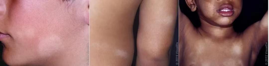 18种皮肤病白斑病,常见皮肤病斑