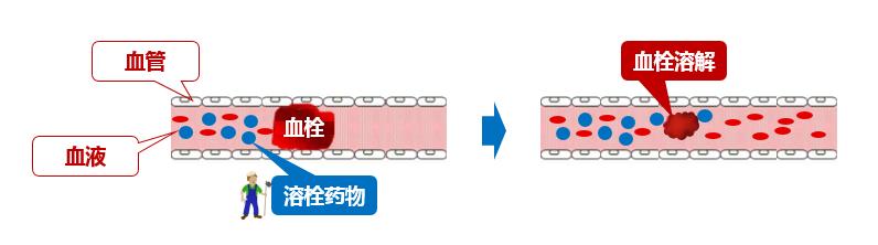 溶栓取栓错过了最佳时机怎么办,脑梗错过溶栓取栓时间后怎么治疗
