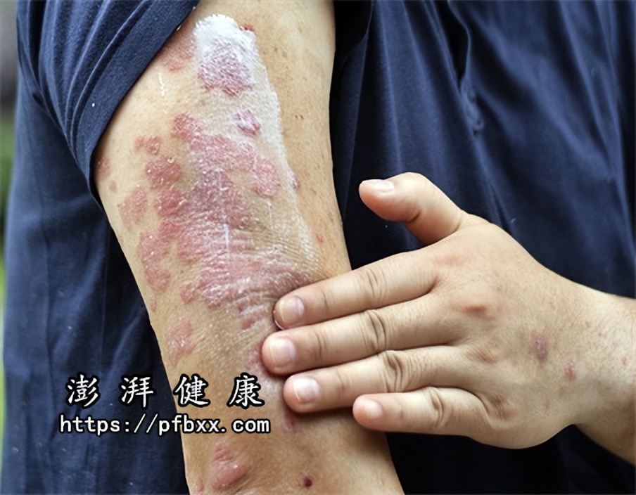 身上腿上出现圆圈样的癣怎么办,腿上长圆圈状的红色癣是什么癣