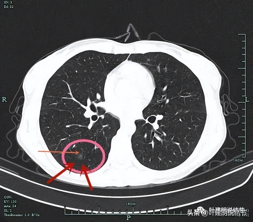 右下叶磨玻璃结节5*4,右下叶磨玻璃样结节多为炎性