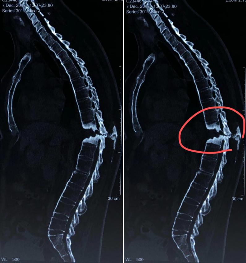 强直性脊柱炎骨折自愈,强直性脊柱炎骨折能恢复好吗