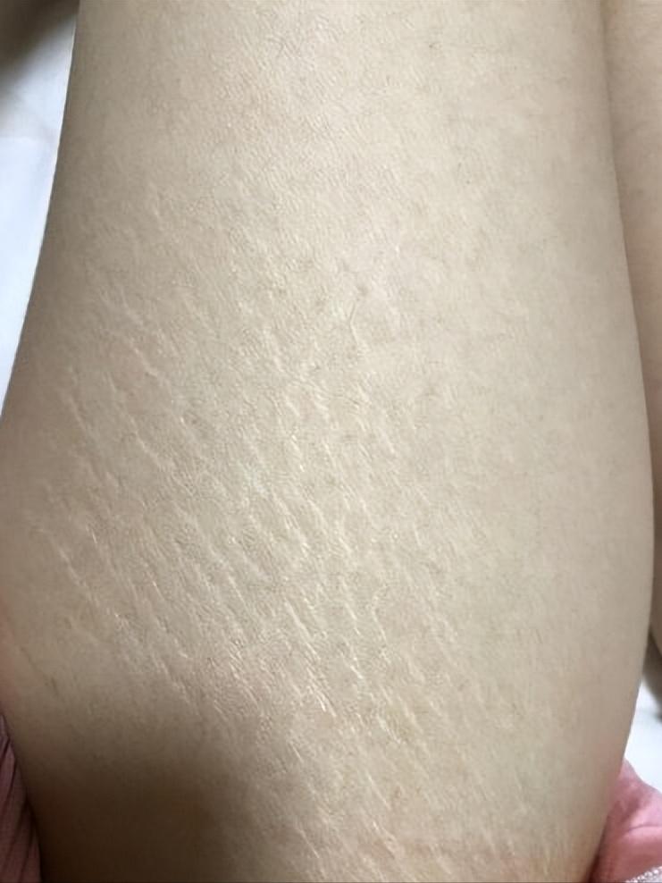 怎么消肥胖纹？吉首俪人教你