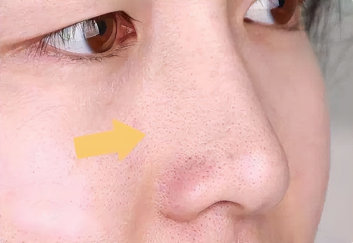 鼻子里挤出的白色细条是螨虫吗,鼻子上的螨虫怎么去除最快方法