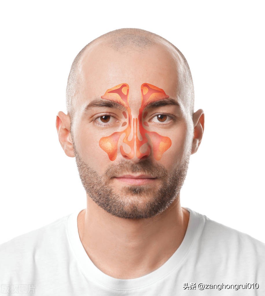 鼻窦炎脾气亏虚型病因病机分析,鼻窦炎病因和注意事项